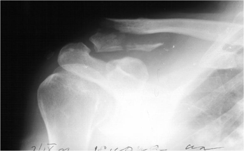 Treatment Of The Lateral End Of The Clavicle Or Acromioclavicular Joint Disruptions